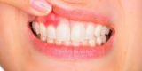 Лечение периодонтита Двухканального зуба 