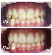 Центральная реставрация зубов: средняя