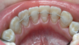 Шинирование зубов: до 6-ти зубов 